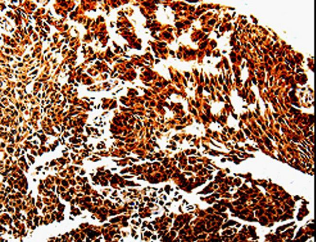 MMP13 Antibody - Immunohistochemistry of paraffin-embedded Human liver cancer using MMP13 Polyclonal Antibody at dilution of 1:10.