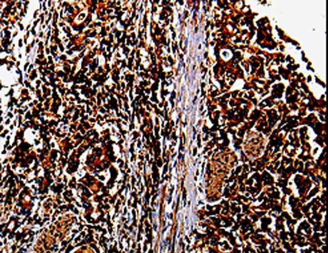 MMP13 Antibody - Immunohistochemistry of paraffin-embedded Human stomach cancer using MMP13 Polyclonal Antibody at dilution of 1:10.