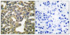 MMP13 Antibody - Peptide - + Immunohistochemical analysis of paraffin-embedded human breast carcinoma tissue using MMP-13 antibody.