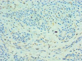MMP14 Antibody - Immunohistochemistry of paraffin-embedded human breast cancer using antibody at 1:100 dilution.