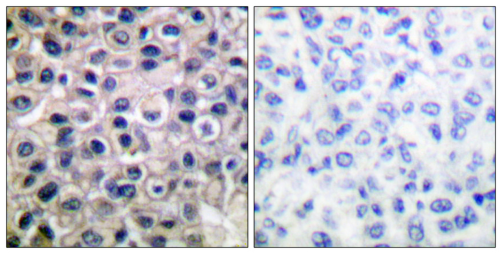 MMP14 Antibody - Immunohistochemistry analysis of paraffin-embedded human breast carcinoma tissue, using MMP-14 Antibody. The picture on the right is blocked with the synthesized peptide.