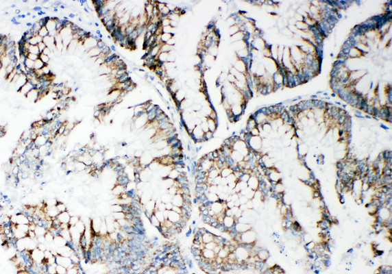 MMP14 Antibody - MMP14 / MMP-14 antibody. IHC(P): Human Intestinal Cancer Tissue.