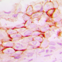 MMP14 Antibody - Immunohistochemical analysis of MMP14 staining in human breast cancer formalin fixed paraffin embedded tissue section. The section was pre-treated using heat mediated antigen retrieval with sodium citrate buffer (pH 6.0). The section was then incubated with the antibody at room temperature and detected using an HRP conjugated compact polymer system. DAB was used as the chromogen. The section was then counterstained with hematoxylin and mounted with DPX.