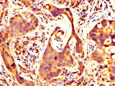 MMP14 Antibody - IHC image of MMP14 Antibody diluted at 1:500 and staining in paraffin-embedded human pancreatic cancer performed on a Leica BondTM system. After dewaxing and hydration, antigen retrieval was mediated by high pressure in a citrate buffer (pH 6.0). Section was blocked with 10% normal goat serum 30min at RT. Then primary antibody (1% BSA) was incubated at 4°C overnight. The primary is detected by a biotinylated secondary antibody and visualized using an HRP conjugated SP system.