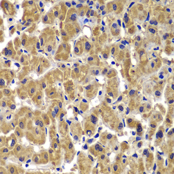 MMP14 Antibody - Immunohistochemistry of paraffin-embedded human liver cancer tissue.
