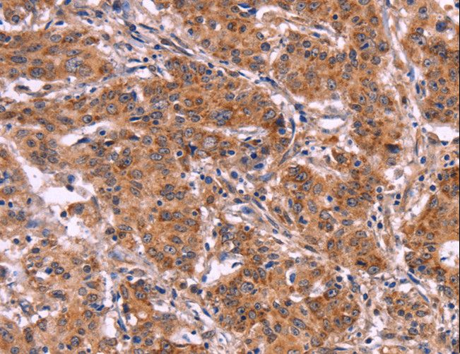 MMP14 Antibody - Immunohistochemistry of paraffin-embedded Human thyroid cancer using MMP14 Polyclonal Antibody at dilution of 1:40.