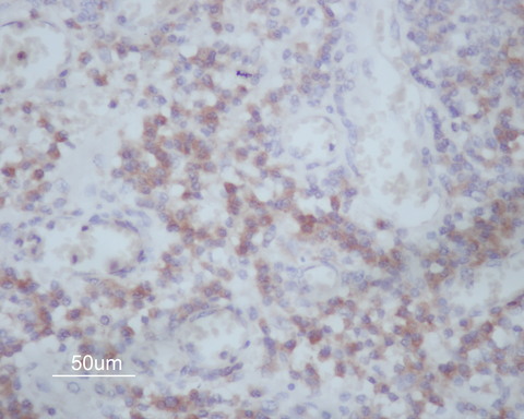 MMP14 Antibody - 1:200 staining human Oral squamous cells carcinoma sections by IHC-P. The tissue was formaldehyde fixed and a heat mediated antigen retrieval step in citrate buffer was performed. The tissue was then blocked and incubated with the antibody for 1.5 hours at 22°C. An HRP conjugated goat anti-rabbit antibody was used as the secondary.