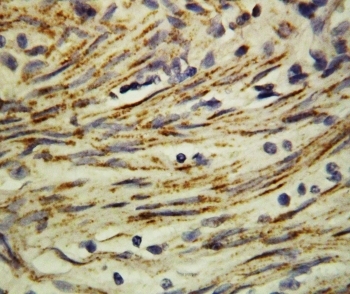 MMP16 Antibody - IHC-P: MMP16 Antibody testing of Human Rectal Cancer Tissue