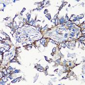 MMP16 Antibody - Immunohistochemistry of paraffin-embedded Human lung cancer using MMP16 Polyclonal Antibody at dilution of 1:100 (40x lens).