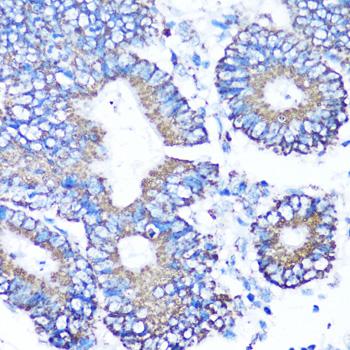 MMP16 Antibody - Immunohistochemistry of paraffin-embedded Human colon carcinoma using MMP16 Polyclonal Antibody at dilution of 1:100 (40x lens).