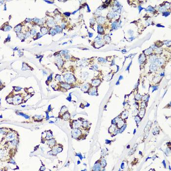 MMP16 Antibody - Immunohistochemistry of paraffin-embedded Human breast cancer using MMP16 Polyclonal Antibody at dilution of 1:100 (40x lens).