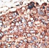 MMP17 Antibody - Formalin-fixed and paraffin-embedded human cancer tissue reacted with the primary antibody, which was peroxidase-conjugated to the secondary antibody, followed by DAB staining. This data demonstrates the use of this antibody for immunohistochemistry; clinical relevance has not been evaluated. BC = breast carcinoma; HC = hepatocarcinoma.