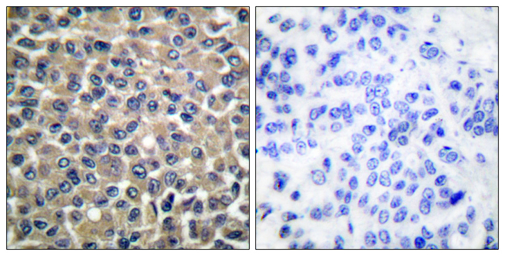 MMP19 Antibody - Immunohistochemistry analysis of paraffin-embedded human breast carcinoma tissue, using MMP-19 Antibody. The picture on the right is blocked with the synthesized peptide.