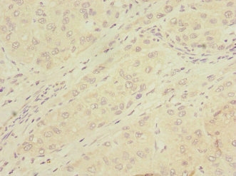 MMP19 Antibody - Immunohistochemistry of paraffin-embedded human liver cancer at dilution 1:100