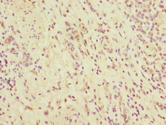 MMP19 Antibody - Immunohistochemistry of paraffin-embedded human bladder cancer at dilution 1:100