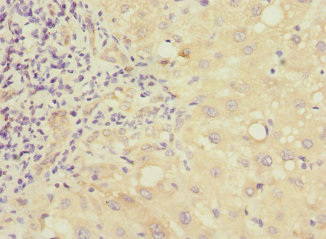 MMP19 Antibody - Immunohistochemistry of paraffin-embedded human liver cancer at dilution 1:100