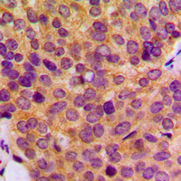 MMP19 Antibody - Immunohistochemical analysis of MMP19 staining in human breast cancer formalin fixed paraffin embedded tissue section. The section was pre-treated using heat mediated antigen retrieval with sodium citrate buffer (pH 6.0). The section was then incubated with the antibody at room temperature and detected using an HRP conjugated compact polymer system. DAB was used as the chromogen. The section was then counterstained with hematoxylin and mounted with DPX.