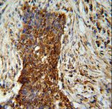 MMP2 Antibody - MMP2 antibody immunohistochemistry of formalin-fixed and paraffin-embedded human lung carcinoma followed by peroxidase-conjugated secondary antibody and DAB staining.