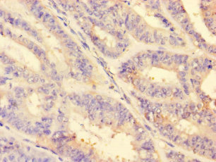 MMP2 Antibody - Immunohistochemistry of paraffin-embedded human endometrial cancer using MMP2 Antibody at dilution of 1:100