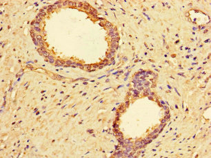 MMP2 Antibody - Immunohistochemistry of paraffin-embedded human prostate cancer using MMP2 Antibody at dilution of 1:100