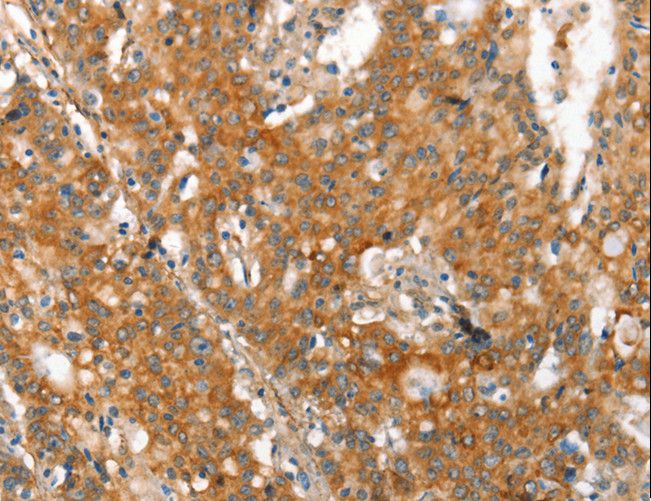 MMP2 Antibody - Immunohistochemistry of paraffin-embedded Human gastric cancer using MMP2 Polyclonal Antibody at dilution of 1:60.