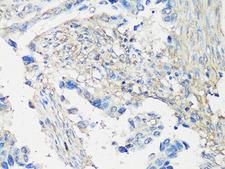 MMP2 Antibody - Immunohistochemistry of paraffin-embedded human lung cancer using MMP2 Antibody at dilution of 1:100 (40x lens).