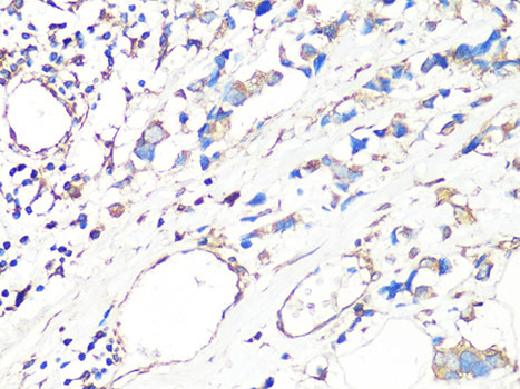 MMP2 Antibody - Immunohistochemistry of paraffin-embedded human breast cancer using MMP2 Antibody at dilution of 1:100 (40x lens).
