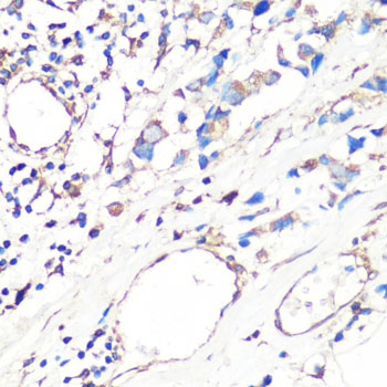 MMP2 Antibody - Immunohistochemistry of paraffin-embedded human mammary cancer using MMP2 antibody at dilution of 1:100 (40x lens).