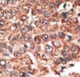 MMP20 Antibody - Formalin-fixed and paraffin-embedded human cancer tissue reacted with the primary antibody, which was peroxidase-conjugated to the secondary antibody, followed by DAB staining. This data demonstrates the use of this antibody for immunohistochemistry; clinical relevance has not been evaluated. BC = breast carcinoma; HC = hepatocarcinoma.
