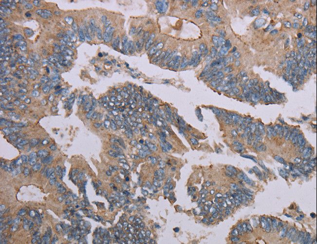 MMP20 Antibody - Immunohistochemistry of paraffin-embedded Human colon cancer using MMP20 Polyclonal Antibody at dilution of 1:40.