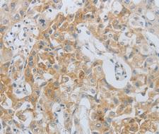 MMP25 / Leukolysin Antibody - Immunohistochemistry of paraffin-embedded Human lung cancer tissue.