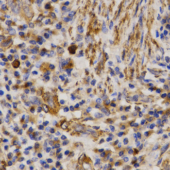 MMP25 / Leukolysin Antibody - Immunohistochemistry of paraffin-embedded human lung cancer tissue.