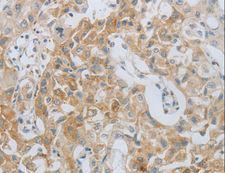 MMP25 / Leukolysin Antibody - Immunohistochemistry of paraffin-embedded Human lung cancer using MMP25 Polyclonal Antibody at dilution of 1:80.