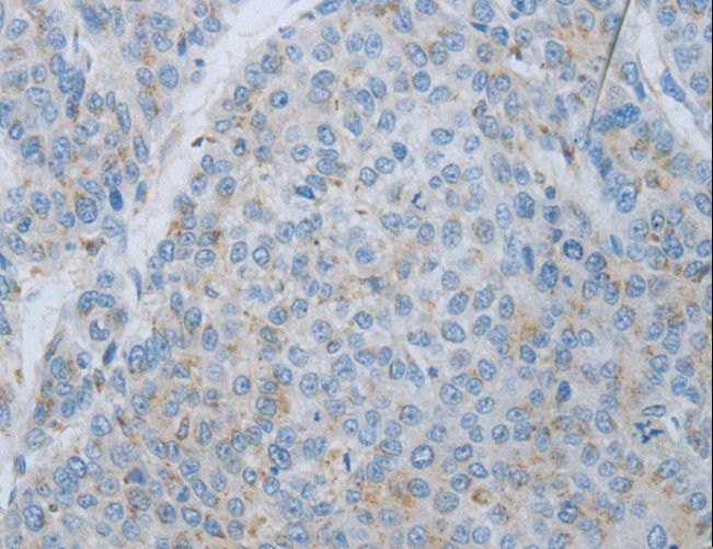 MMP25 / Leukolysin Antibody - Immunohistochemistry of paraffin-embedded Human liver cancer using MMP25 Polyclonal Antibody at dilution of 1:80.