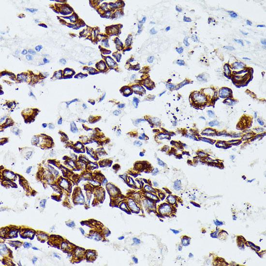 MMP25 / Leukolysin Antibody - Immunohistochemistry of paraffin-embedded Human lung cancer using MMP25 Polyclonal Antibody at dilution of 1:100 (40x lens).