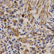 MMP25 / Leukolysin Antibody - Immunohistochemistry of paraffin-embedded Human lung cancer using MMP25 Polyclonal Antibody at dilution of 1:200 (40x lens).