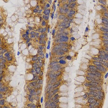 MMP25 / Leukolysin Antibody - Immunohistochemistry of paraffin-embedded Human rectal cancer using MMP25 Polyclonal Antibody at dilution of 1:200 (40x lens).