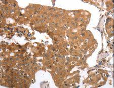 MMP27 Antibody - Immunohistochemistry of paraffin-embedded Human breast cancer using MMP27 Polyclonal Antibody at dilution of 1:40.
