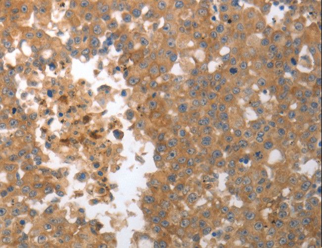 MMP27 Antibody - Immunohistochemistry of paraffin-embedded Human ovarian cancer using MMP27 Polyclonal Antibody at dilution of 1:50.
