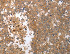 MMP27 Antibody - Immunohistochemistry of paraffin-embedded Human ovarian cancer using MMP27 Polyclonal Antibody at dilution of 1:50.