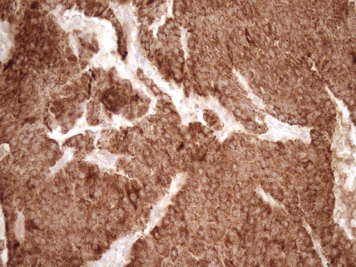 MMP3 Antibody - Immunohistochemical staining of paraffin-embedded Carcinoma of Human lung tissue using anti-MMP3 mouse monoclonal antibody. (Heat-induced epitope retrieval by 1 mM EDTA in 10mM Tris, pH8.5, 120C for 3min,