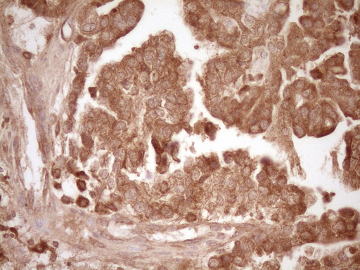 MMP3 Antibody - Immunohistochemical staining of paraffin-embedded Adenocarcinoma of Human ovary tissue using anti-MMP3 mouse monoclonal antibody. (Heat-induced epitope retrieval by 1 mM EDTA in 10mM Tris, pH8.5, 120C for 3min,