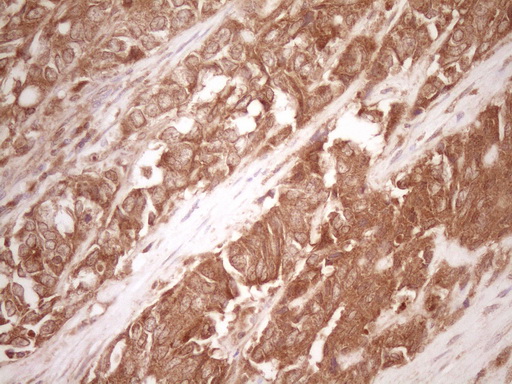 MMP3 Antibody - Immunohistochemical staining of paraffin-embedded Adenocarcinoma of Human endometrium tissue using anti-MMP3 mouse monoclonal antibody. (Heat-induced epitope retrieval by 1 mM EDTA in 10mM Tris, pH8.5, 120C for 3min,