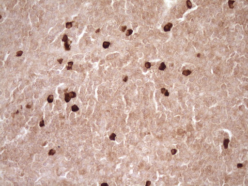 MMP3 Antibody - Immunohistochemical staining of paraffin-embedded Human tonsil within the normal limits using anti-MMP3 mouse monoclonal antibody. (Heat-induced epitope retrieval by 1 mM EDTA in 10mM Tris, pH8.5, 120C for 3min,