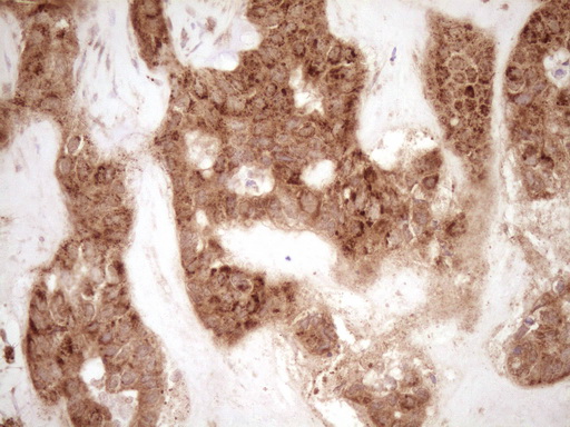 MMP3 Antibody - Immunohistochemical staining of paraffin-embedded Carcinoma of Human liver tissue using anti-MMP3 mouse monoclonal antibody. (Heat-induced epitope retrieval by 1 mM EDTA in 10mM Tris, pH8.5, 120C for 3min,