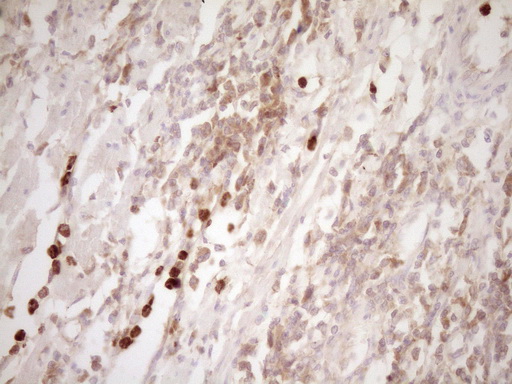 MMP3 Antibody - IHC of paraffin-embedded Human colon tissue using anti-MMP3 mouse monoclonal antibody. (Heat-induced epitope retrieval by 1 mM EDTA in 10mM Tris, pH8.5, 120°C for 3min).