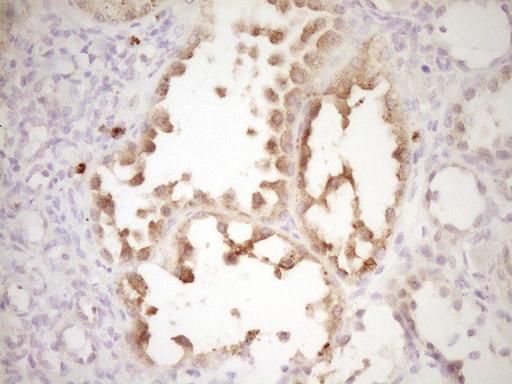 MMP3 Antibody - IHC of paraffin-embedded Human Kidney tissue using anti-MMP3 mouse monoclonal antibody. (Heat-induced epitope retrieval by 1 mM EDTA in 10mM Tris, pH8.5, 120°C for 3min).