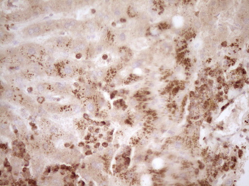 MMP3 Antibody - IHC of paraffin-embedded Human liver tissue using anti-MMP3 mouse monoclonal antibody. (Heat-induced epitope retrieval by 1 mM EDTA in 10mM Tris, pH8.5, 120°C for 3min).