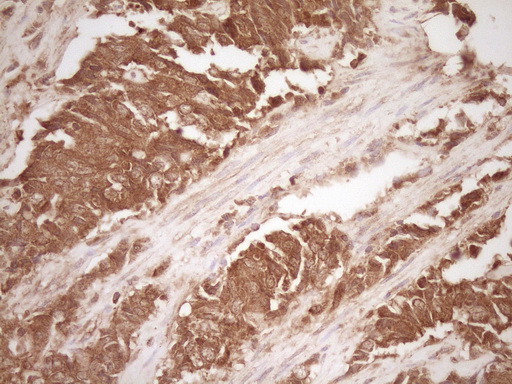MMP3 Antibody - IHC of paraffin-embedded Adenocarcinoma of Human endometrium tissue using anti-MMP3 mouse monoclonal antibody. (Heat-induced epitope retrieval by 1 mM EDTA in 10mM Tris, pH8.5, 120°C for 3min).
