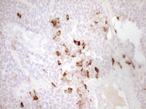 MMP3 Antibody - Immunohistochemical staining of paraffin-embedded Carcinoma of Human lung tissue using anti-MMP3 mouse monoclonal antibody. (Heat-induced epitope retrieval by 1 mM EDTA in 10mM Tris, pH8.5, 120C for 3min,